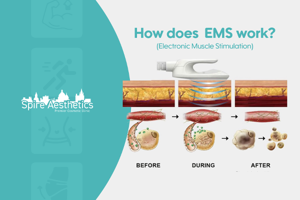 EMS treatment for post pregnancy weight loss treatment Portsmouth