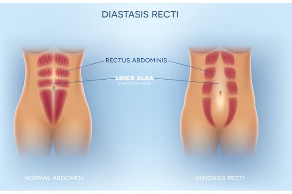What Non-Surgical Options Are Available for Diastasis Recti Portsmouth?