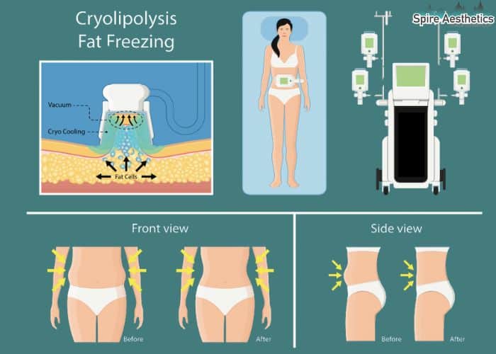 Image of diet and fat freezing combined for best results for Spire Aesthetics Portsmouth