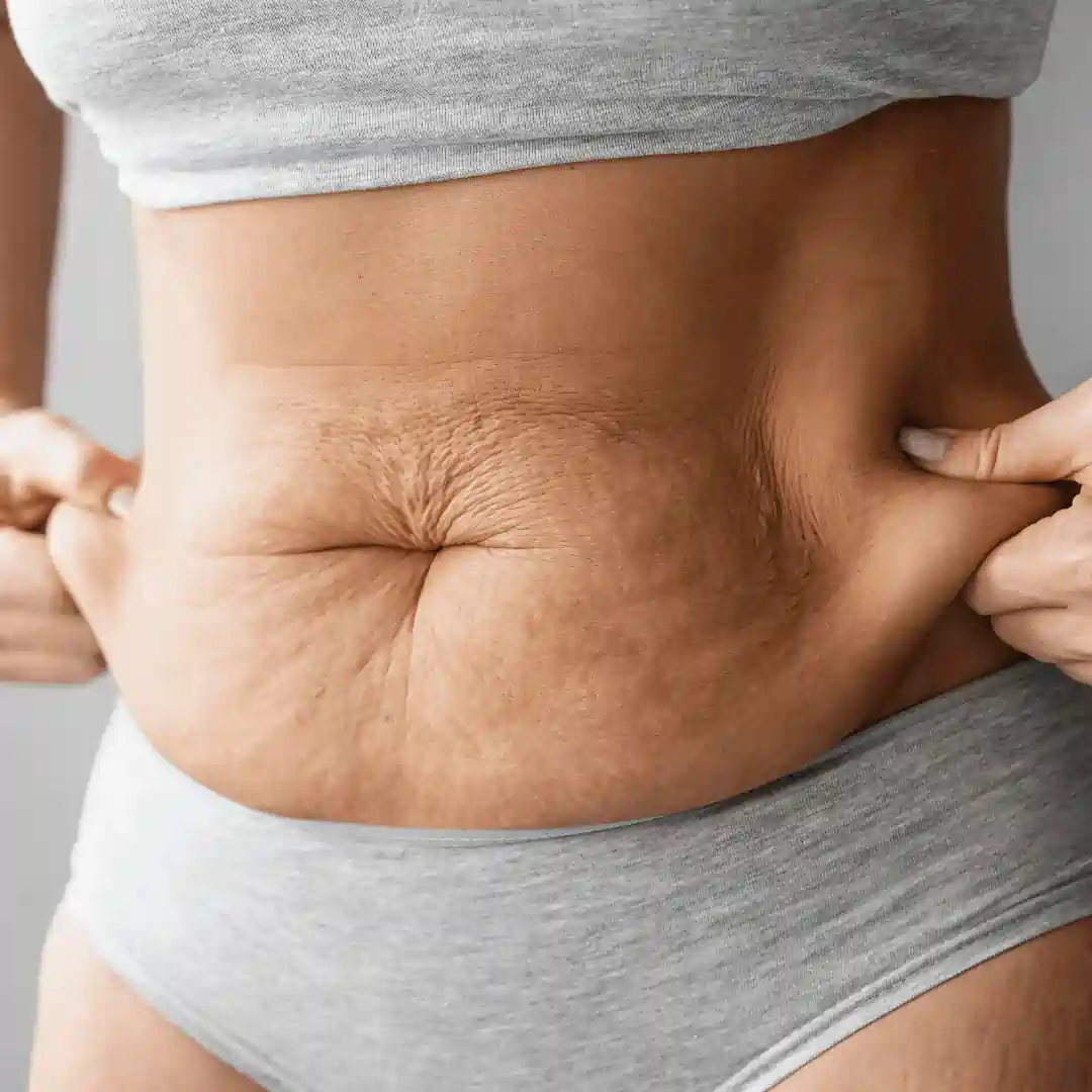 Is It Normal to Have Loose Skin After Pregnancy Portsmouth?