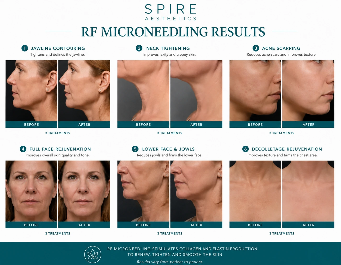 RF Microneedling Skin tightening Portsmouth results
