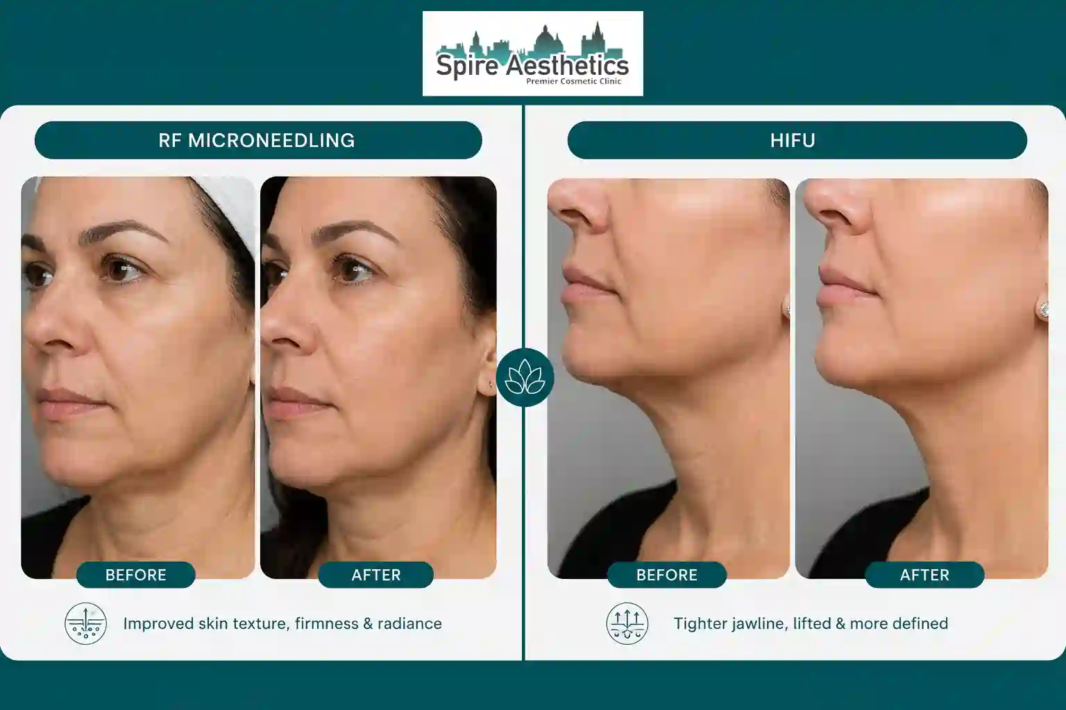 Can RF Microneedling and HIFU Be Combined Portsmouth?