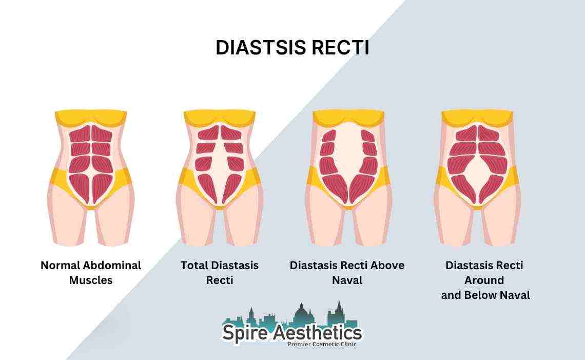 Is Non-Surgical Diastasis Recti Treatment Right for You? Common Concerns Answered Portsmouth